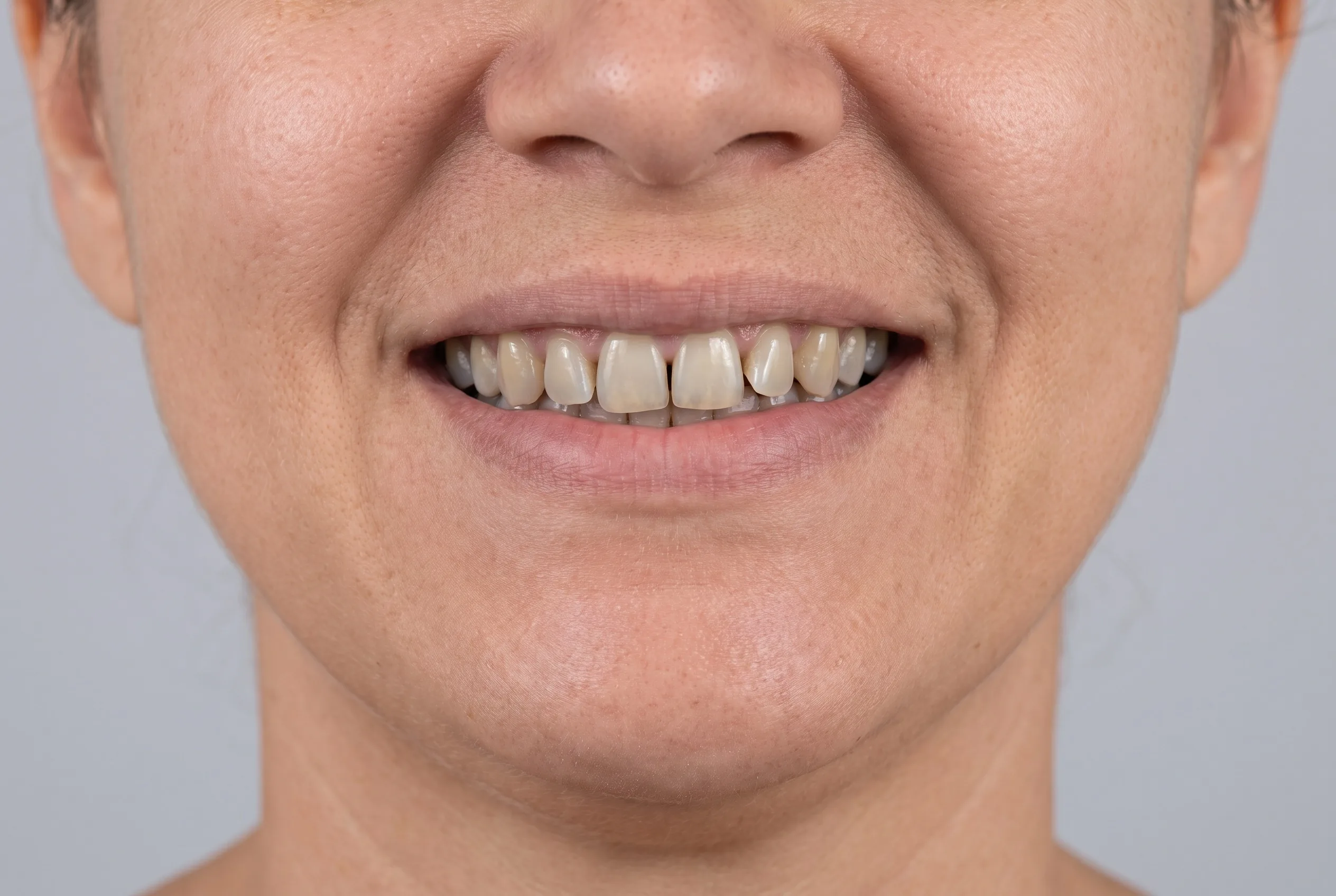 Sorriso antes do tratamento